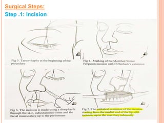 Surgical Steps:
Step .1: Incision
 