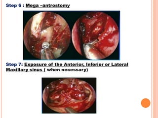 Step 6 : Mega –antrostomy
Step 7: Exposure of the Anterior, Inferior or Lateral
Maxillary sinus ( when necessary)
 