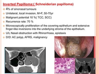 Inverted Papilloma:( Schneiderian papilloma)
 4% of sinonasal tumours
 Unilateral, local invasion, M>F, 50-70yr
 Malignant potential 10 %( TCC, SCC)
 Recurrence rate: 70 %
 Microscopically proliferation of the covering epithelium and extensive
finger-like inversions into the underlying stroma of the epithelium.
 U/L Nasal obstruction with Rhinorrhoea, epistaxis
 D/D: AC polyp, AFRS, malignancy
 