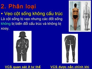 2. Phân loại2. Phân loại
• Vẹo cột sống không cấu trúcVẹo cột sống không cấu trúc
Là cột sống bị vẹo nhưng các đốt sốngLà cột sống bị vẹo nhưng các đốt sống
khôngkhông bị biến đổi cấu trúc và không bịbị biến đổi cấu trúc và không bị
xoay.xoay.
VCS quan sát ở tư thế VCS được nắn chỉnh khi
 