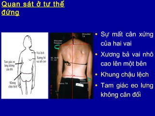 Quan sát ở tư thế
đứng
• Sự mất cân xứng
của hai vai
• Xương bả vai nhô
cao lên một bên
• Khung chậu lệchKhung chậu lệch
• Tam giác eo lưngTam giác eo lưng
không cân đốikhông cân đối
 