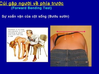 Cúi gập người về phía trước
(Forward Bending Test)
Sự xoắn vặn của cột sống (Bướu sườn)
 