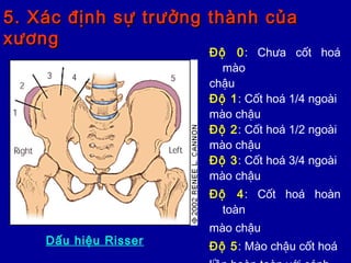 5. Xác định sự trưởng thành của5. Xác định sự trưởng thành của
xươngxương
Độ 0: Chưa cốt hoá
mào
chậu
Độ 1: Cốt hoá 1/4 ngoài
mào chậu
Độ 2: Cốt hoá 1/2 ngoài
mào chậu
Độ 3: Cốt hoá 3/4 ngoài
mào chậu
Độ 4: Cốt hoá hoàn
toàn
mào chậu
Độ 5: Mào chậu cốt hoáDấu hiệu Risser
 