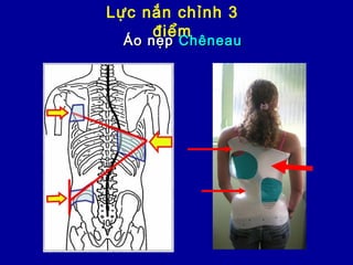 Lực nắn chỉnh 3
điểm
Áo nẹpÁo nẹp ChêneauChêneau
 