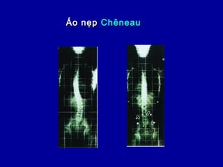 Áo nẹpÁo nẹp ChêneauChêneau
 