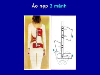 Áo nẹpÁo nẹp 3 mảnh3 mảnh
 