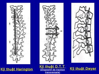 Kỹ thuật Harington
Kỹ thuật D.T.T
(Dispositif de traction
transversale)
Kỹ thuật Dwyer
 