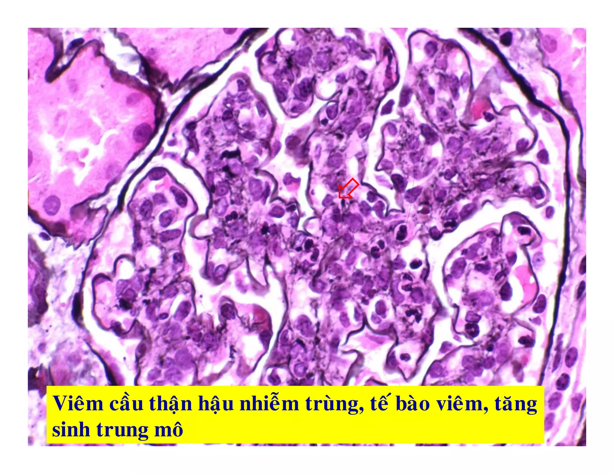 
1717
Vieâm caàu thaän haäu nhieãm truøng, teá baøo vieâm, taêng
sinh trung moâ
 