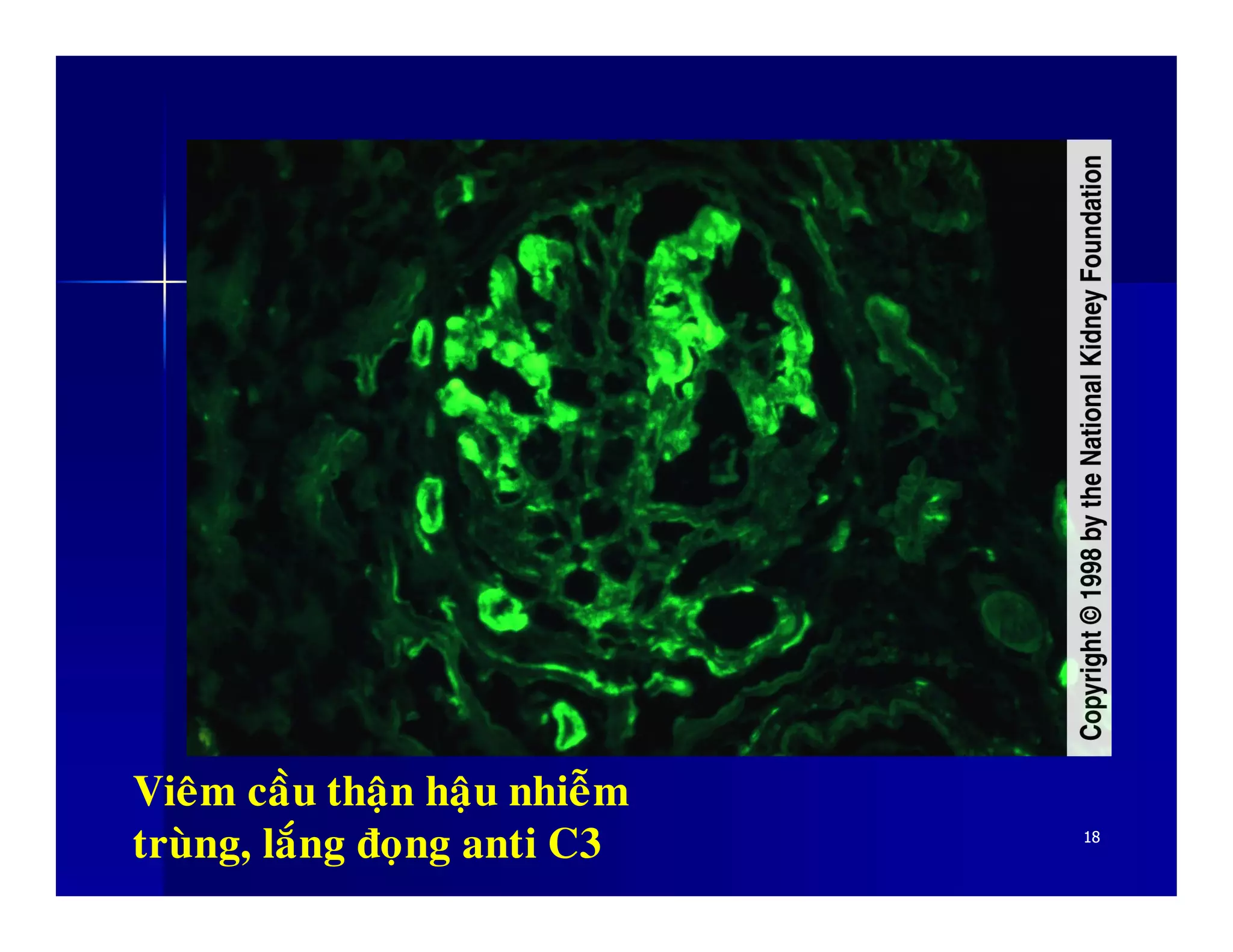 1818
Vieâm caàu thaän haäu nhieãm
truøng, laéng ñoïng anti C3
 