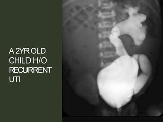 A 2YROLD
CHILD H/O
RECURRENT
UTI
 