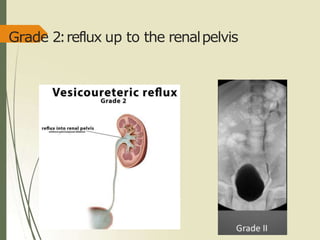 Grade 2:reflux up to the renalpelvis
 