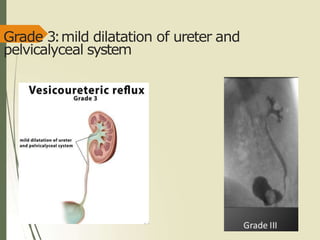 Grade 3:mild dilatation of ureter and
pelvicalyceal system
 