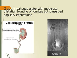 Grade 4 :tortuous ureter with moderate
dilatation blunting of fornices but preserved
papillary impressions
 