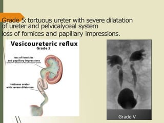 Grade 5:tortuous ureter with severe dilatation
of ureter and pelvicalyceal system
loss of fornices and papillary impressions.
 