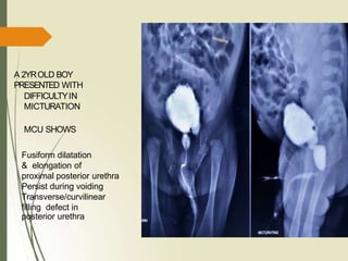 A 2YROLD BOY
PRESENTED WITH
DIFFICULTYIN
MICTURATION
MCU SHOWS
Fusiform dilatation
& elongation of
proximal posterior urethra
Persist during voiding
Transverse/curvilinear
filling defect in
posterior urethra
 