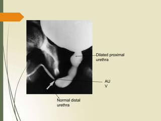 Dilated proximal
urethra
AU
V
Normal distal
urethra
 