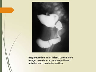 megalourethra in an infant. Lateral mcu
image reveals an extensively dilated
anterior and posterior urethra
 