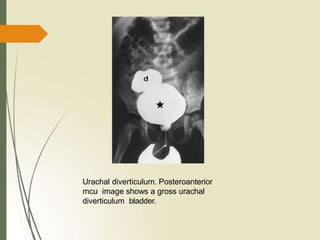 Urachal diverticulum. Posteroanterior
mcu image shows a gross urachal
diverticulum bladder.
 