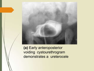 (a) Early anteroposterior
voiding cystourethrogram
demonstrates a ureterocele
 