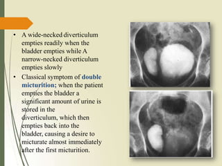 • A wide-necked diverticulum
empties readily when the
bladder empties while A
narrow-necked diverticulum
empties slowly
• Classical symptom of double
micturition; when the patient
empties the bladder a
significant amount of urine is
stored in the
diverticulum, which then
empties back into the
bladder, causing a desire to
micturate almost immediately
after the first micturition.
 