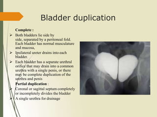 Bladder duplication
Complete :
 Both bladders lie side by
side, separated by a peritoneal fold.
Each bladder has normal musculature
and mucosa,
 Ipsilateral ureter drains into each
bladder.
 Each bladder has a separate urethral
orifice that may drain into a common
urethra with a single penis, or there
may be complete duplication of the
urethra and penis
Partial duplication :
 Coronal or sagittal septum completely
or incompletely divides the bladder
 A single urethra for drainage
 