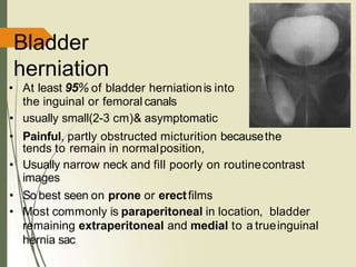 Bladder
herniation
• At least 95% of bladder herniationis into
the inguinal or femoral canals
• usually small(2-3 cm)& asymptomatic
• Painful, partly obstructed micturition becausethe
tends to remain in normalposition,
• Usually narrow neck and fill poorly on routinecontrast
images
• So best seen on prone or erectfilms
• Most commonly is paraperitoneal in location, bladder
remaining extraperitoneal and medial to a trueinguinal
hernia sac
 