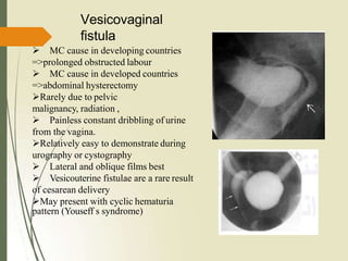  MC cause in developing countries
=>prolonged obstructed labour
 MC cause in developed countries
=>abdominal hysterectomy
Rarely due to pelvic
malignancy, radiation ,
 Painless constant dribbling of urine
from the vagina.
Relatively easy to demonstrate during
urography or cystography
 Lateral and oblique films best
 Vesicouterine fistulae are a rare result
of cesarean delivery
May present with cyclic hematuria
pattern (Youseff s syndrome)
Vesicovaginal
fistula
 
