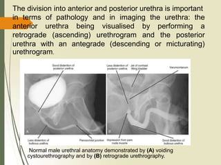 The division into anterior and posterior urethra is important
in terms of pathology and in imaging the urethra: the
anterior urethra being visualised
retrograde (ascending) urethrogram
by performing a
and the posterior
urethra with an antegrade (descending or micturating)
urethrogram.
Normal male urethral anatomy demonstrated by (A) voiding
cystourethrography and by (B) retrograde urethrography.
 
