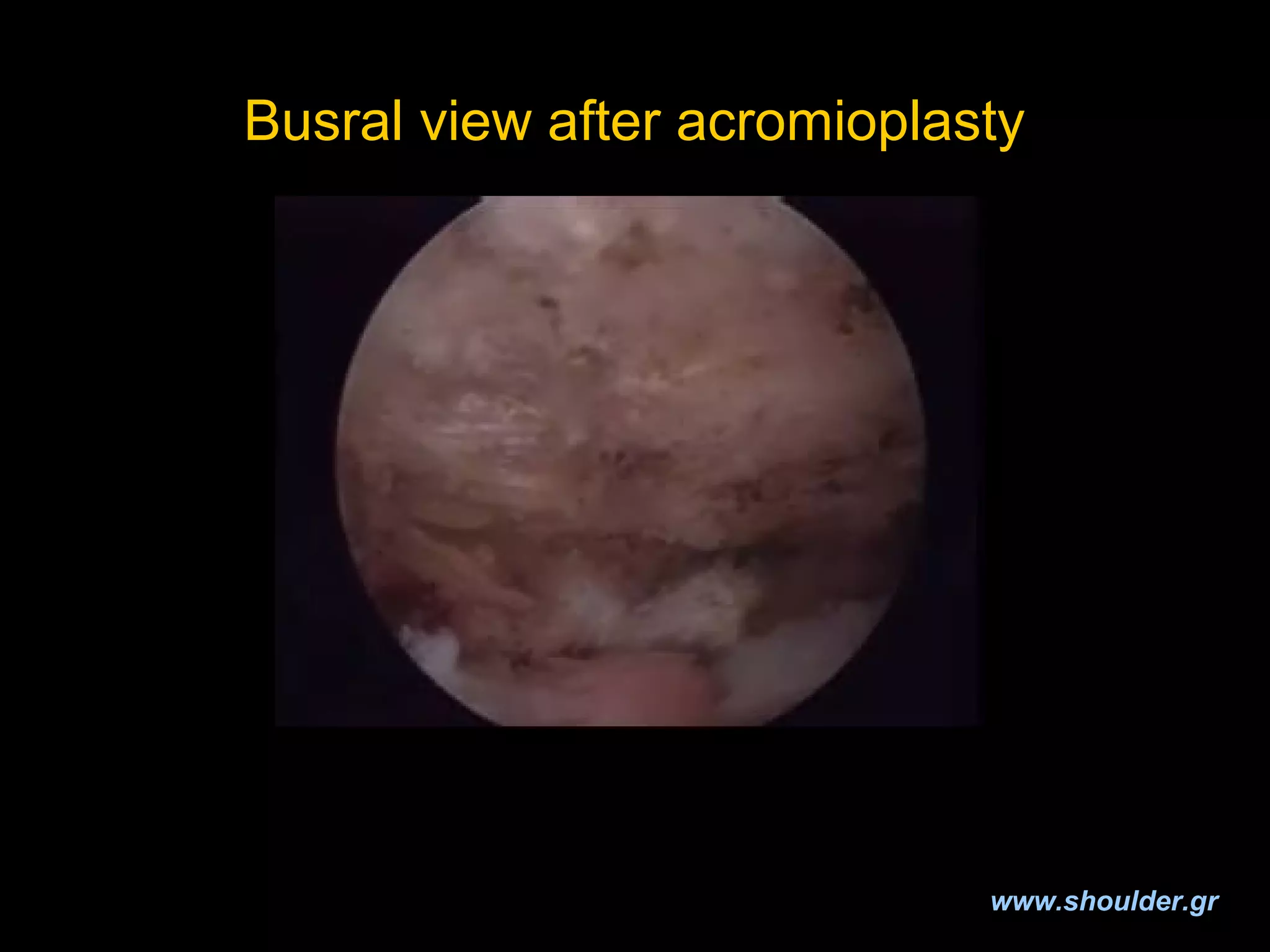 Rotator cuff 2008 final | PPT