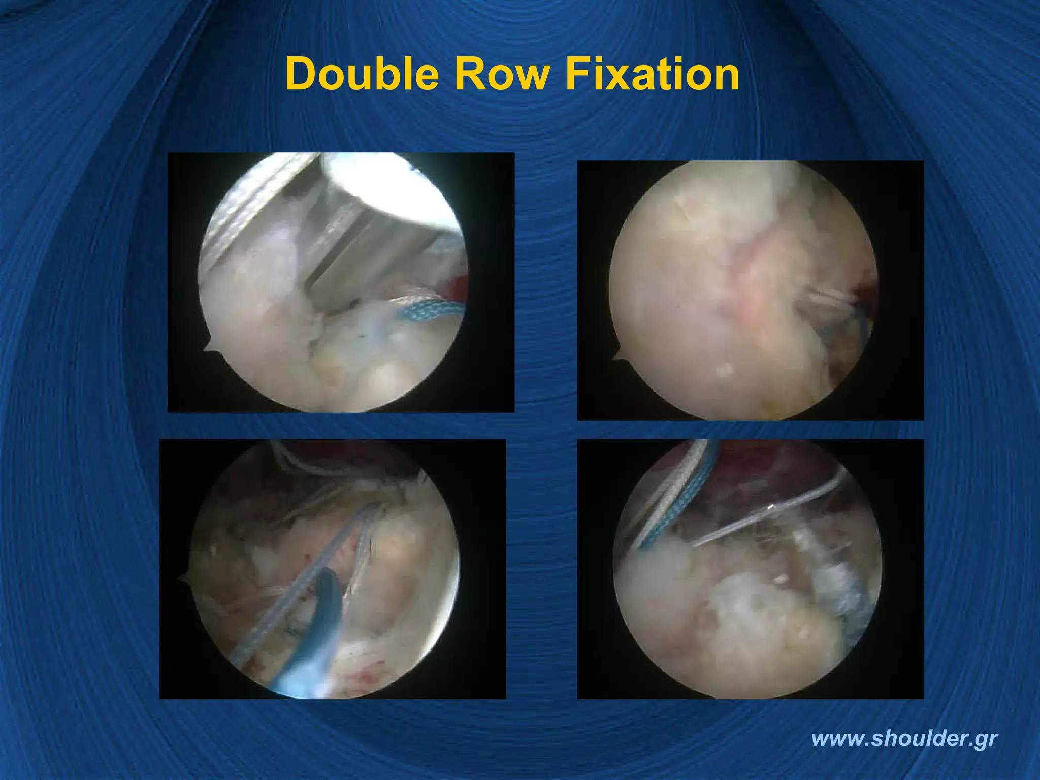 Rotator cuff 2008 final | PPT