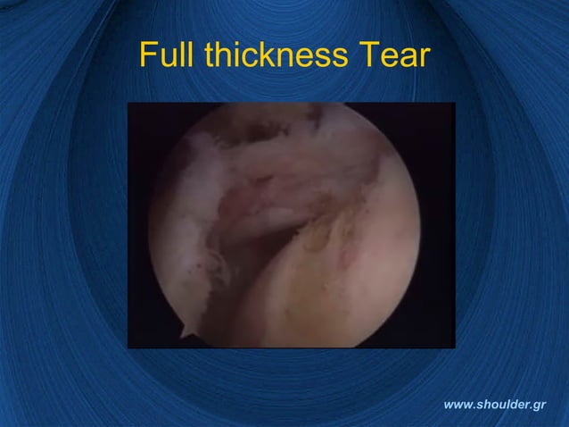 Rotator cuff 2008 final | PPT