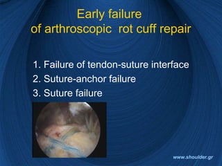 Early failure
of arthroscopic rot cuff repair
1. Failure of tendon-suture interface
2. Suture-anchor failure
3. Suture failure
www.shoulder.gr
 