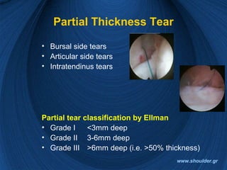 Partial Thickness Tear
• Bursal side tears
• Articular side tears
• Intratendinus tears
Partial tear classification by Ellman
• Grade I <3mm deep
• Grade II 3-6mm deep
• Grade III >6mm deep (i.e. >50% thickness)
www.shoulder.gr
 