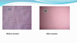 Before stenter After stenter
 