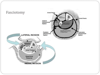 Fasciotomy Instrument vdocuments.net_orthopaedic-emergencies.pptx