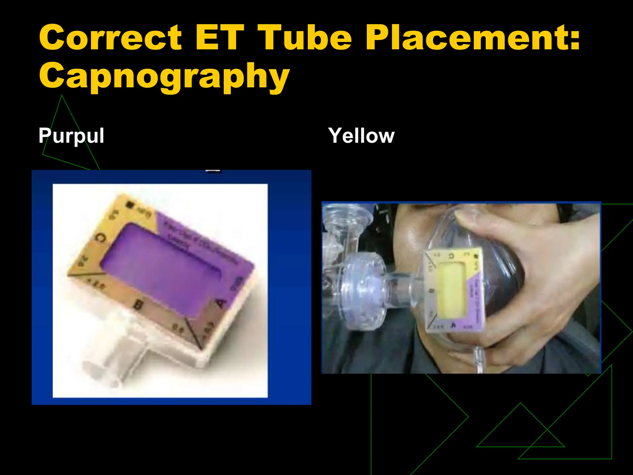 Correct ET Tube Placement:
Capnography
Purpul Yellow
 