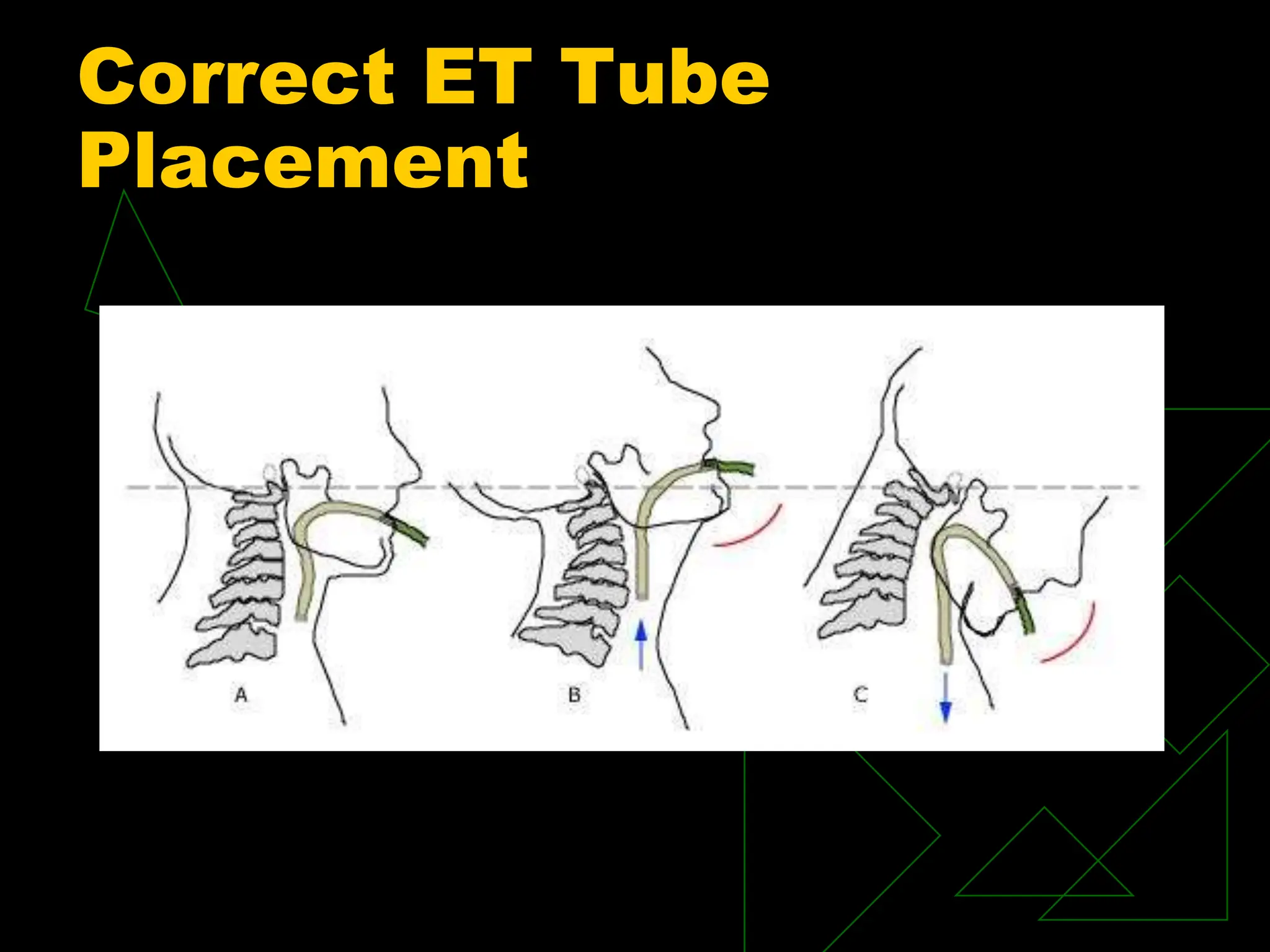 Correct ET Tube
Placement
 
