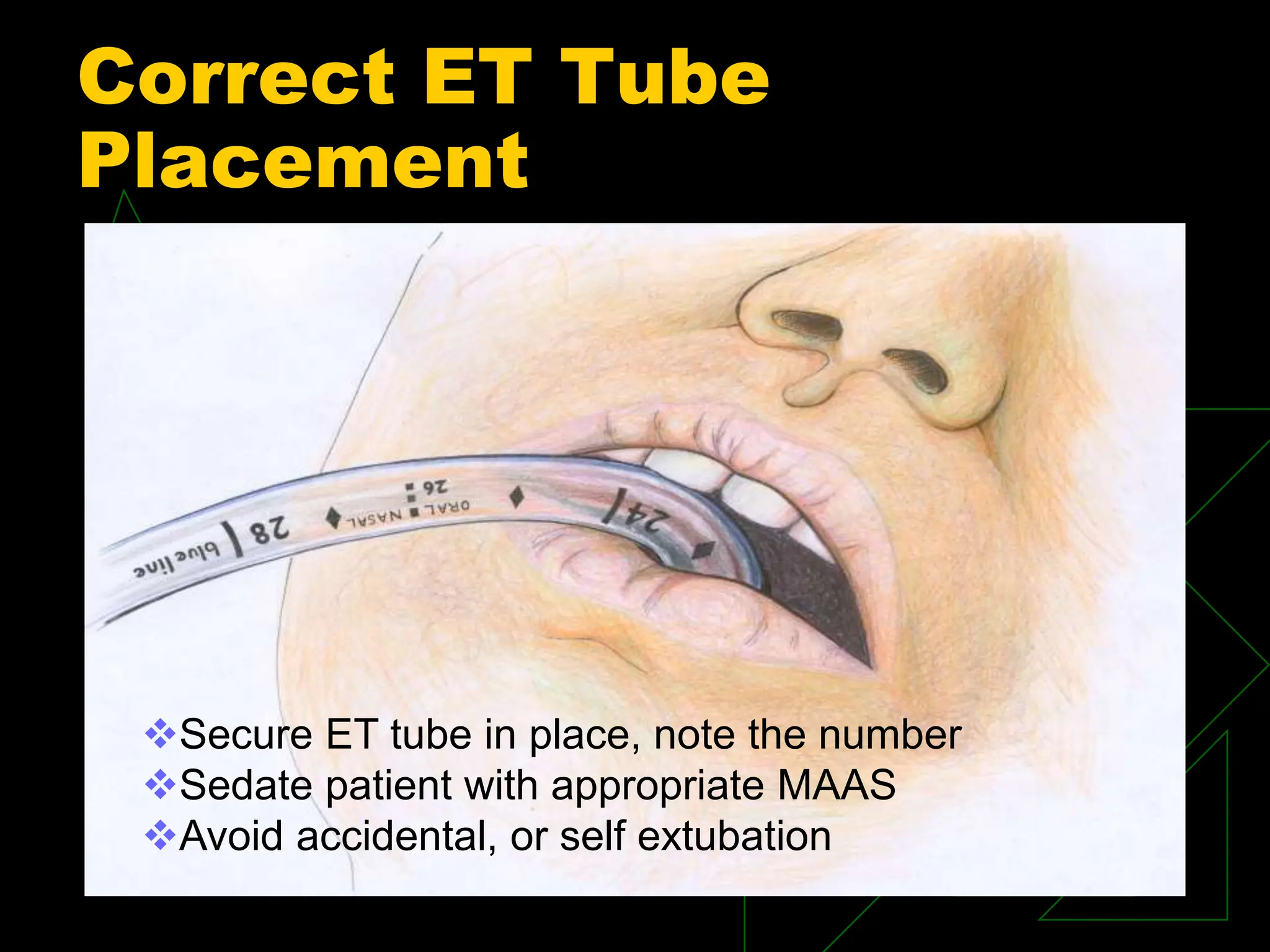 Correct ET Tube
Placement
Secure ET tube in place, note the number
Sedate patient with appropriate MAAS
Avoid accidental, or self extubation
 