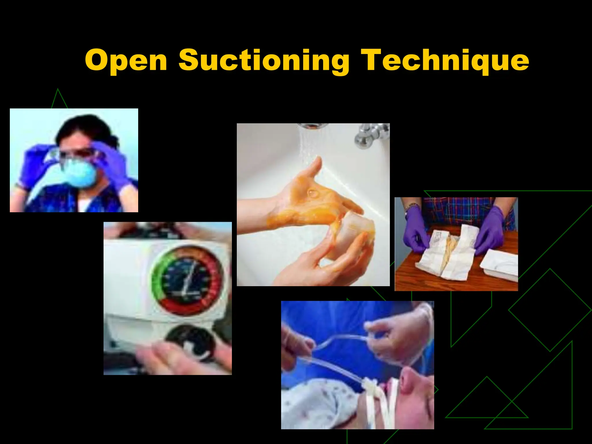 Open Suctioning Technique
 