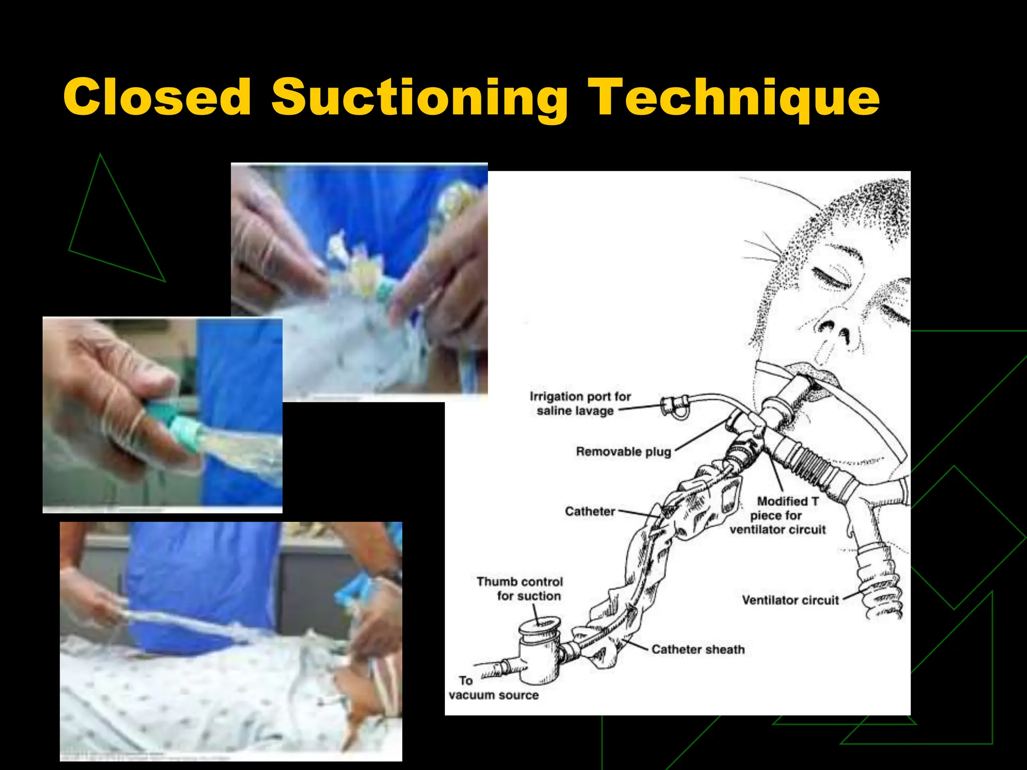 Closed Suctioning Technique
 