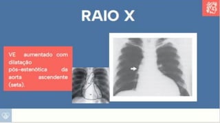 Apresentação sobre Sobrecarga de Ventrículo Esquerdo