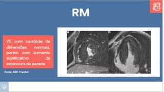 Apresentação sobre Sobrecarga de Ventrículo Esquerdo