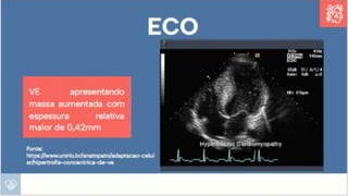 Apresentação sobre Sobrecarga de Ventrículo Esquerdo