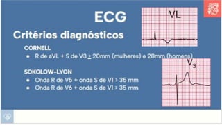 Apresentação sobre Sobrecarga de Ventrículo Esquerdo