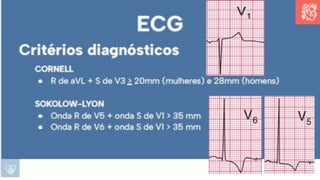Apresentação sobre Sobrecarga de Ventrículo Esquerdo
