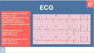 Apresentação sobre Sobrecarga de Ventrículo Esquerdo