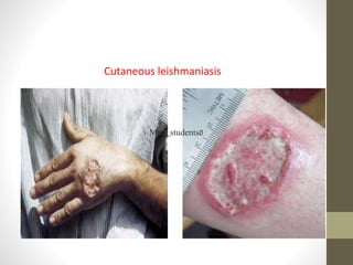 Cutaneous leishmaniasis
Med_students0
 
