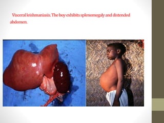 Visceralleishmaniasis.Theboyexhibitssplenomegalyanddistended
.abdomen
 