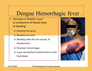 Dengue Hemorrhagic fever
29/53
• Decrease in Platelet count
(a component of blood) leads
to bleeding
o Bleeding from gums
o Bleeding into joints
o Bleeding under the skin causing its
discolouration
o Petecheal hemorrhages
o In gut causing black colored stools or even
frank blood
10/11/2023 Prof Muhammad Tauseef Jawaid
 