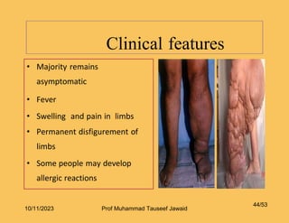 Clinical features
44/53
• Majority remains
asymptomatic
• Fever
• Swelling and pain in limbs
• Permanent disfigurement of
limbs
• Some people may develop
allergic reactions
10/11/2023 Prof Muhammad Tauseef Jawaid
 